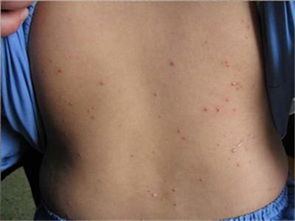 中医解读牛皮癣发病机理