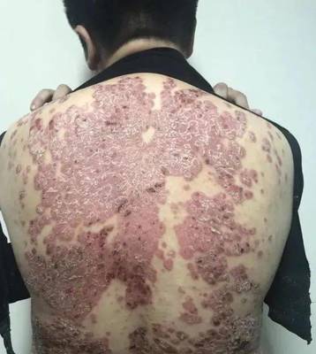 【科普】“顽疾”银屑病会传染吗?如何治疗?市一医院皮肤科专家带你走进治疗新时代