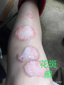 皮肤顽疾为什么好的那么快,原来秘密在这