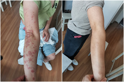 牛皮癣##银屑病# 根治银屑癣评论区联系,银屑病是一种慢性,复发性