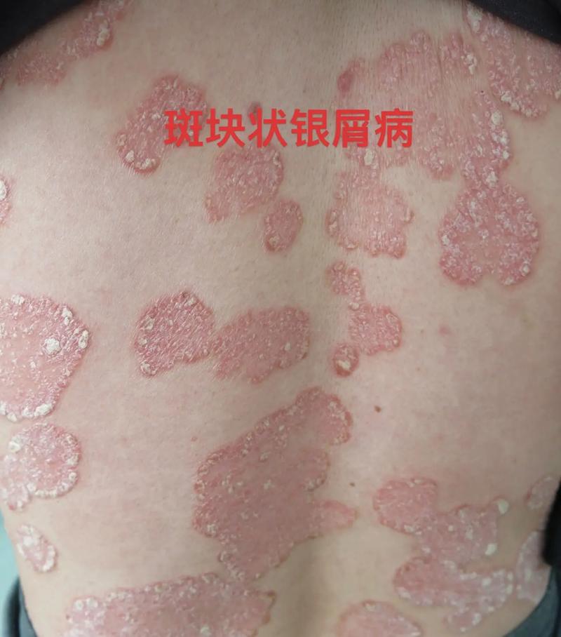 银屑病,俗称牛皮癣,为皮肤科常见病.但有的患者不熟悉,不了解