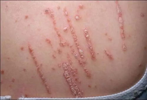 银屑病是哪些原因造成的呢 哪些因素会造成银屑病恶化呢