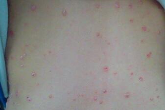 红皮型牛皮癣初期会有哪些具体表现