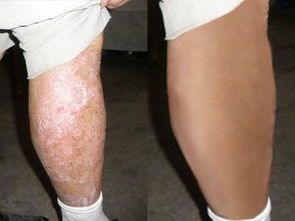 皮肤痒,还反复 牛皮癣 银屑病 你还想忍多久