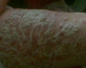 牛皮癣患者吃的水果