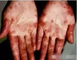 食用菌产品的神奇见证 白癫风 牛皮癣 红斑狼疮