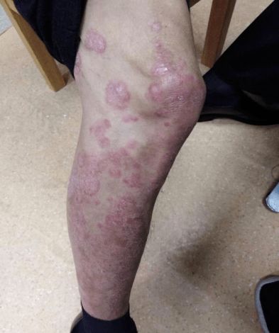 银屑病患者福音 新型靶向治疗药物 生物制剂