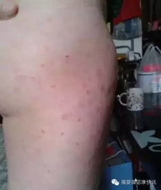 牛皮癣的克星 讲述一位严重牛皮癣康复过程