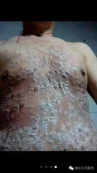 越来越多的牛皮癣患者重获健康,您为什么不能试一试呢