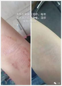 口碑 明星产品 蟾酥湿疹膏