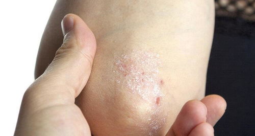 几块钱一瓶的甲硝唑,或能帮助摆平这4种病,你了解吗