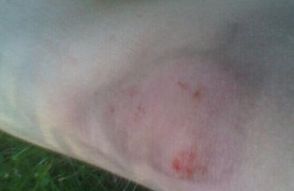 沈阳牛皮癣医院该如何选择