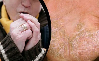 十大银屑病发病原因|引起银屑病诱因和治疗方法