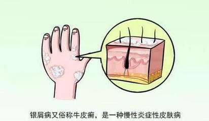 牛皮癣的病因与发病机制解析