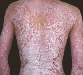 男性红皮病型牛皮癣的预防措施与注意事项