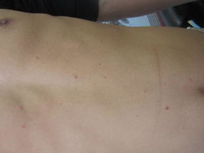 长春中吉皮肤病医院 牛皮癣专业治疗与康复指南