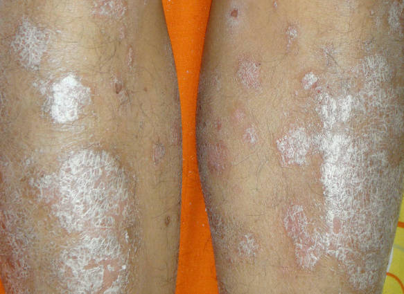 身上长白花花的牛皮癣是什么原因引起的？