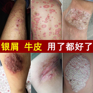 牛皮成人外用软膏 非激素止痒良方，专治银屑病与各种癣症