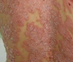 牛皮癣患者为何应避免食用生冷食物