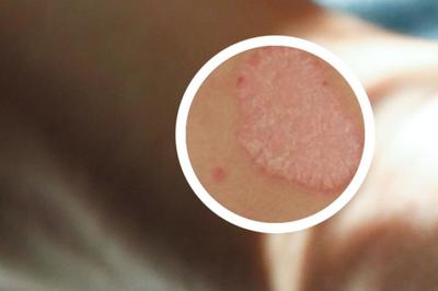 鸵鸟油在银屑病（牛皮癣）治疗中的认知与局限性