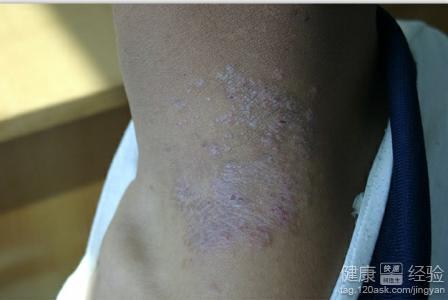 得了牛皮癣怎么办？科学认识与应对之道