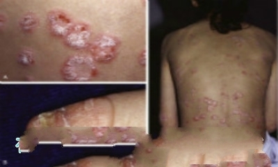 银屑病治疗前后对比 正确认识牛皮癣的改善与康复