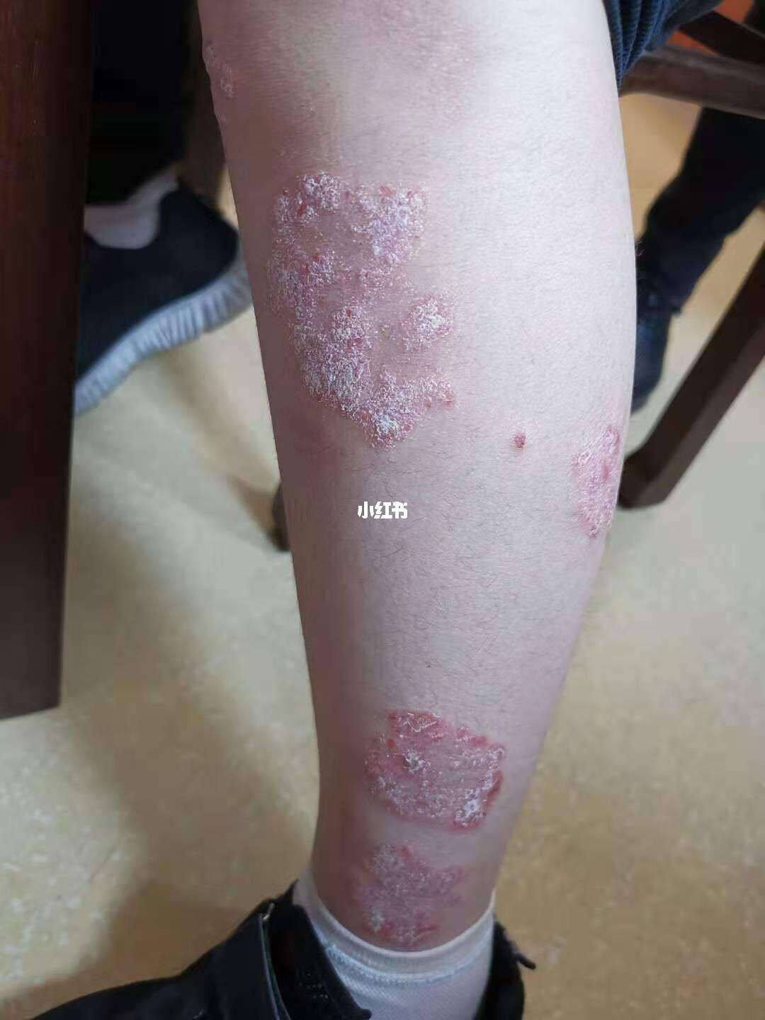 牛皮癣的病程演变 从初期征兆到后期形态的详细对比