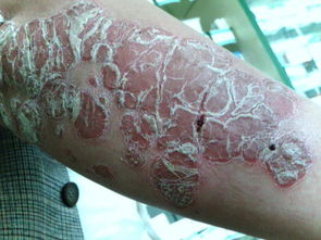 严重牛皮癣的视觉警示与深度解析