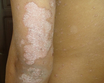 河南哪家医院牛皮癣治的好?牛皮癣一定不能吃辣椒吗?