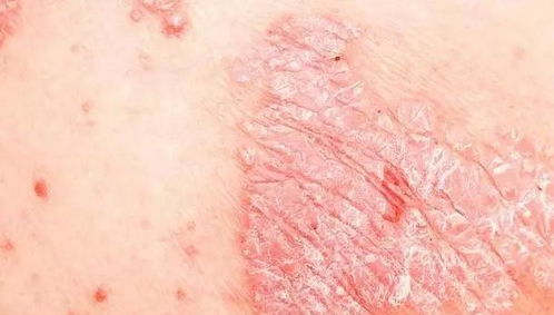 水果不自由 那么牛皮癣 湿疹和荨麻疹三大皮肤病该如何吃水果