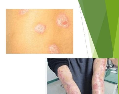 牛皮癣基本常识