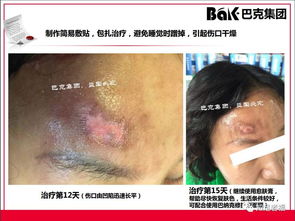 一切皮肤病及外伤的克星,传统文化义工的事业 巴克产品介绍