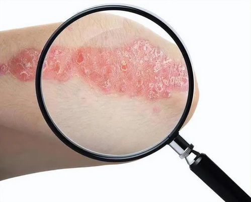 十大顽固皮肤病揭秘 湿疹仅居第六，榜首之症愿您永不沾染