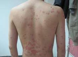 中年脓疱型牛皮癣的临床鉴别诊断与综合管理