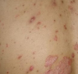 牛皮癣内服药全解析 从传统到生物制剂的选择