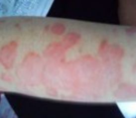 牛皮癣的民间偏方 理性看待与科学治疗的重要性