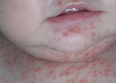 婴儿牛皮癣与遗传因素 揭开背后的科学联系