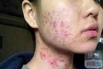 面部牛皮癣的科学治疗与有效护理方法