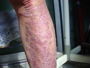 典型银屑病皮损示例与临床特征解析